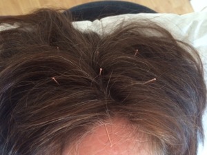 scalp